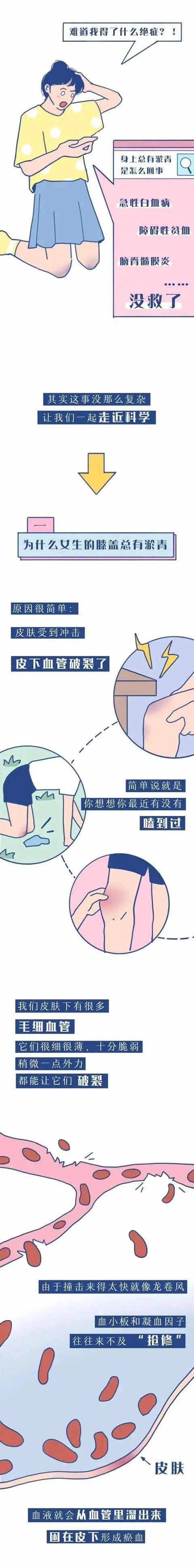 女生膝盖淤青是什么意思（女生膝盖无缘无故有淤青是什么意思）